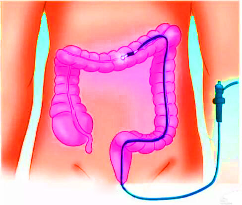 直腸癌早期有哪些癥狀？